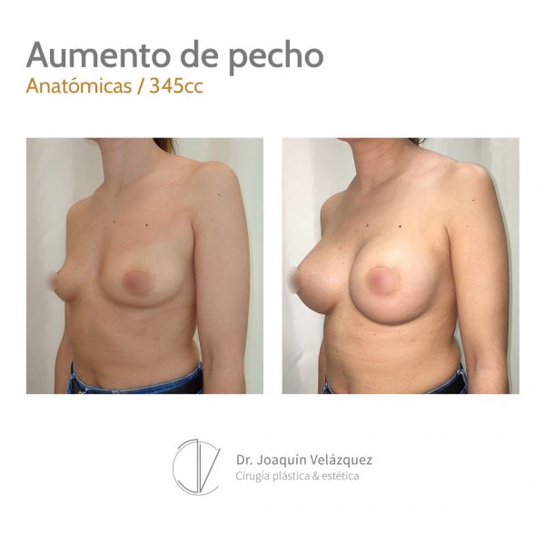 aumento de pecho en sevilla doctor joaquin velazquez