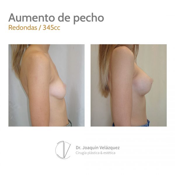 aumento de pecho protesis redondas sevilla