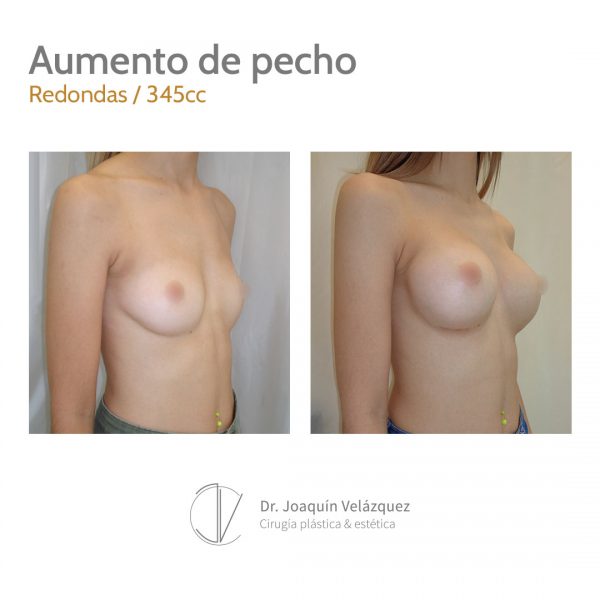 aumento de pecho antes y despues en sevilla