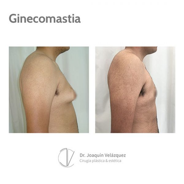 antes y despues operacion ginecomastia