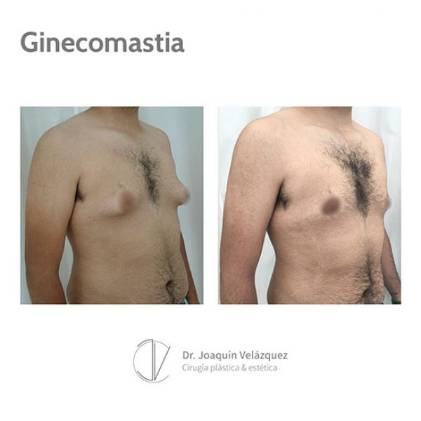 antes y despues ginecomastia sevilla