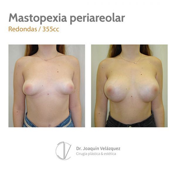 resultados mastopexia merida