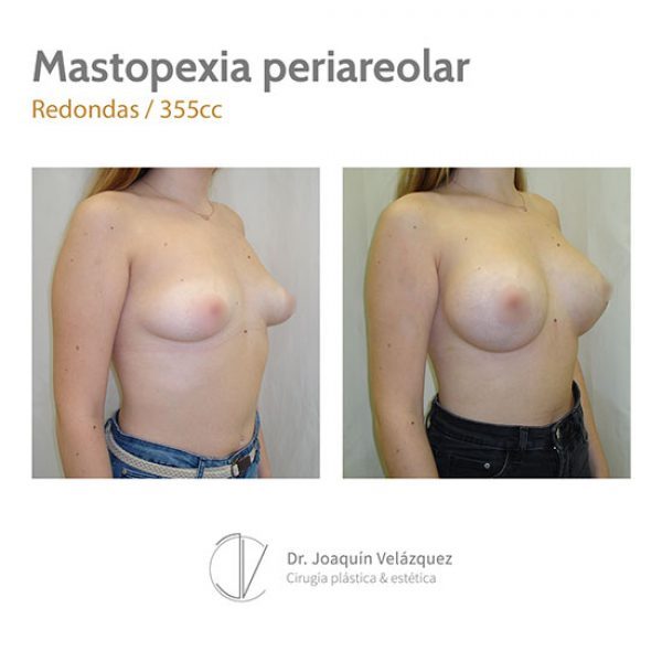 antes despues elevacion pecho merida