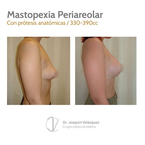 antes y despues cirugia mamas tuberosas