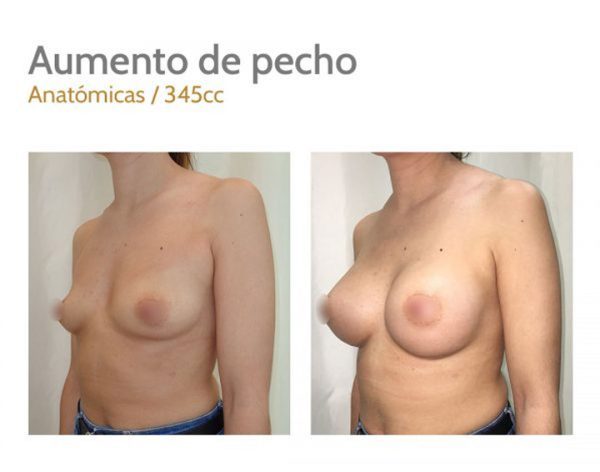aumento de pecho en merida antes despues