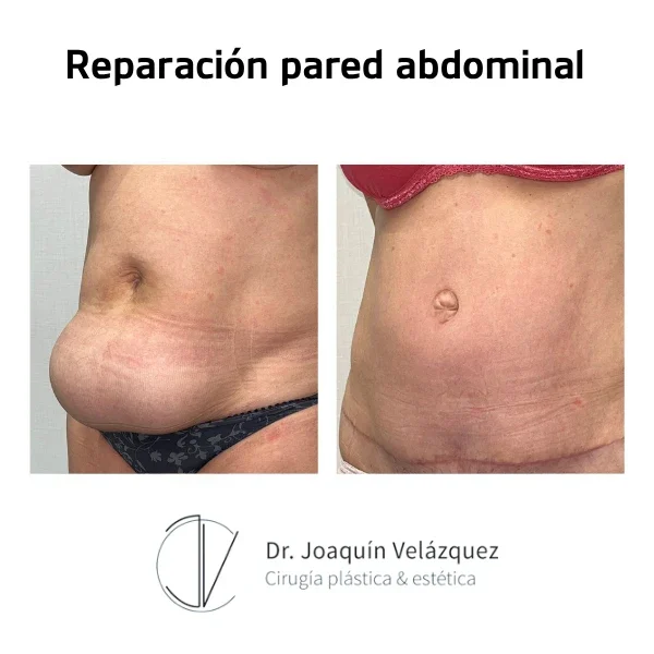 Cirugía pared abdominal en Sevilla resultados