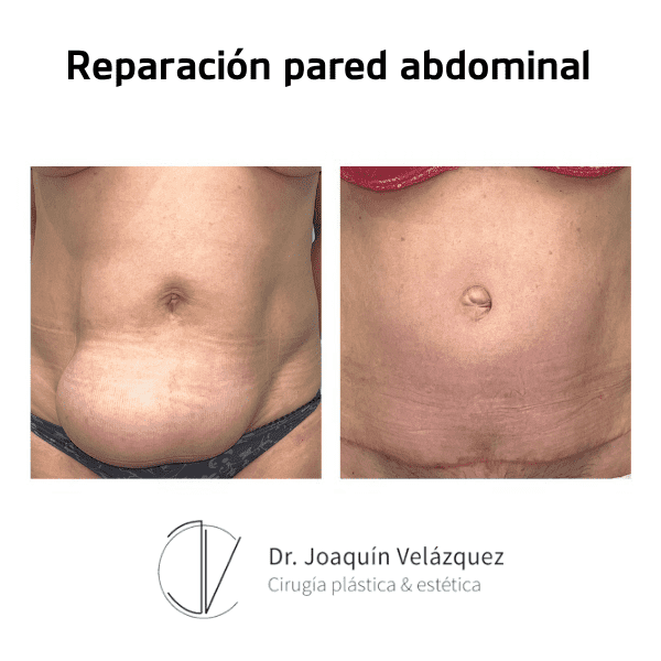 reparacion-pared-abdominal-antes-despues-1