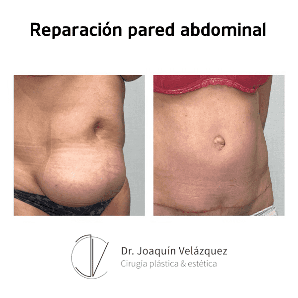 reparacion-pared-abdominal-antes-despues-2