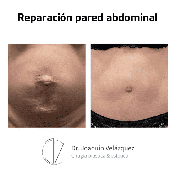 reparacion-pared-abdominal-antes-despues-3
