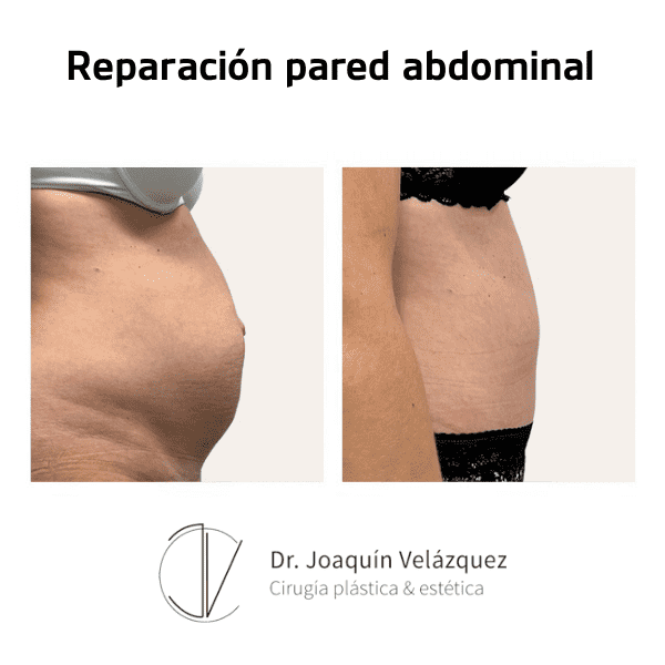 reparacion-pared-abdominal-antes-despues-4