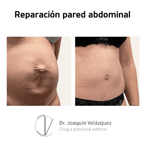 reparacion-pared-abdominal-antes-despues-5